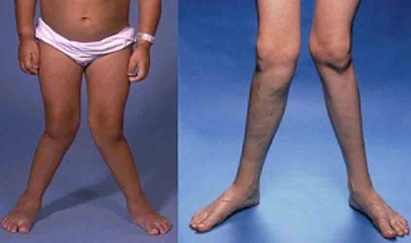 Consulta pública pode mudar a vida de pacientes com raquitismo hipofosfatêmico ligado ao cromossomo X (XLH)