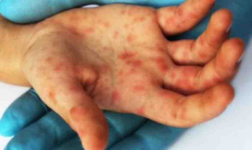 Síndrome mão-pé-boca volta a ser incidente em crianças brasileiras