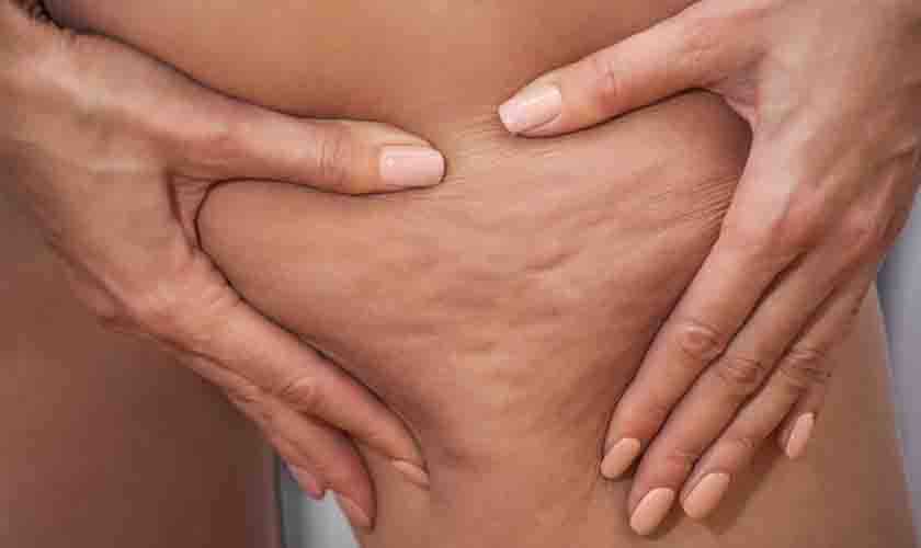 Hormônios x Lipedema: qual a relação?