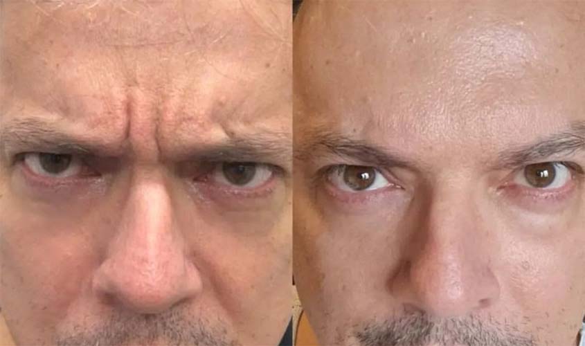 'Não é preciso ter rugas para se submeter ao Botox, mas sim, fazer para não ter rugas', afirma Dr. Thiago Marra, médico e cirurgião plástico