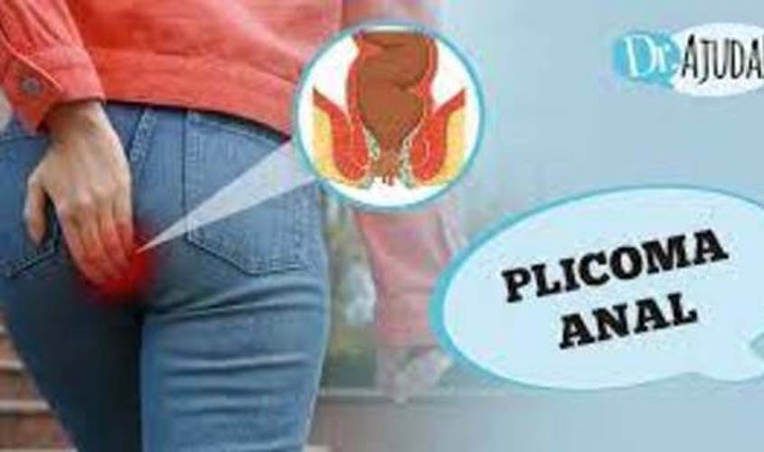 Plicoma Anal: o que é e como tratar?