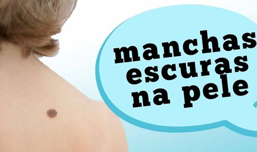MELANOMA: Quando uma mancha escura na pela pode ser sinal de câncer