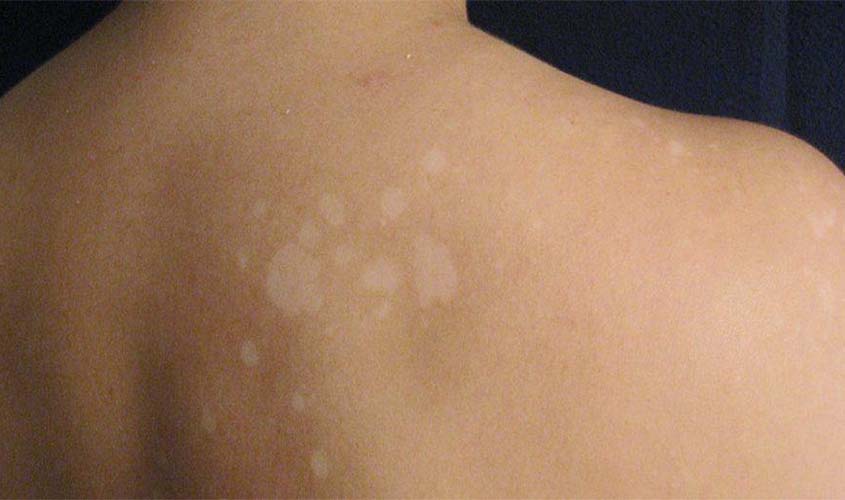 Em 20 anos, hanseníase atinge quase 800 mil brasileiros, aponta levantamento da Sociedade Brasileira de Dermatologia