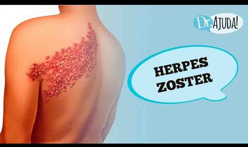 Bolhas, feridas e dor: o que é herpes zoster?