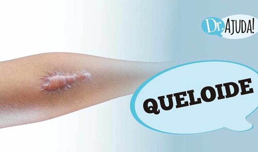 Queloide: o que é, tratamento e como evitar?
